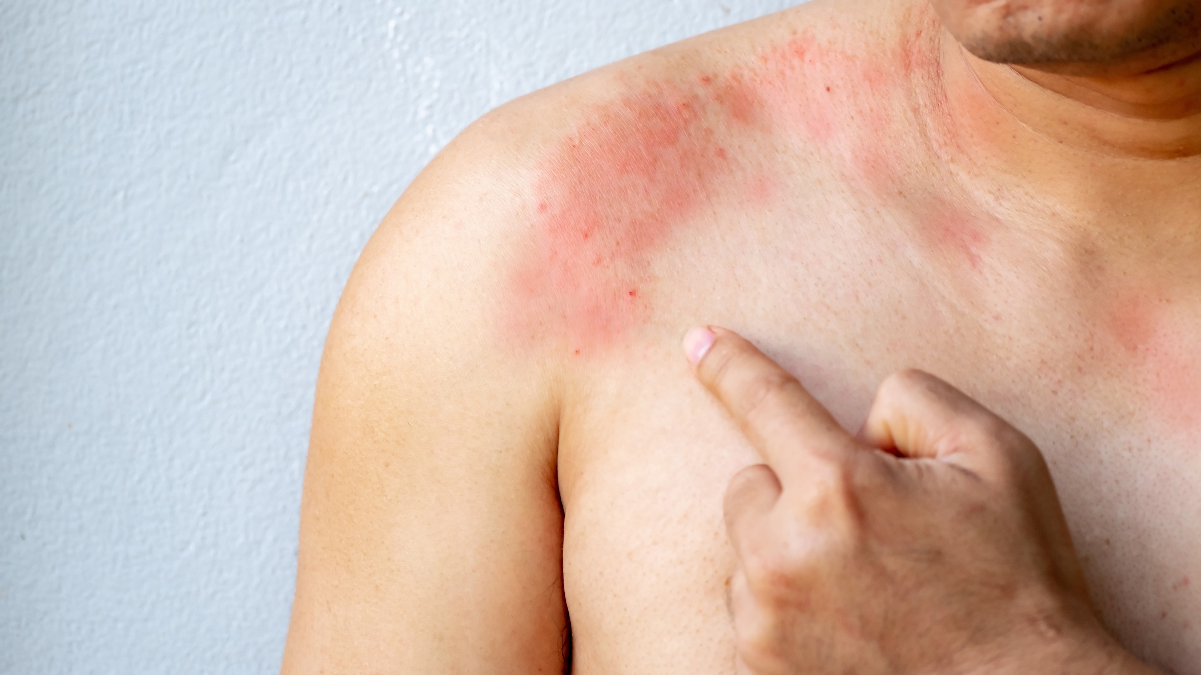 Fungal infection on skin