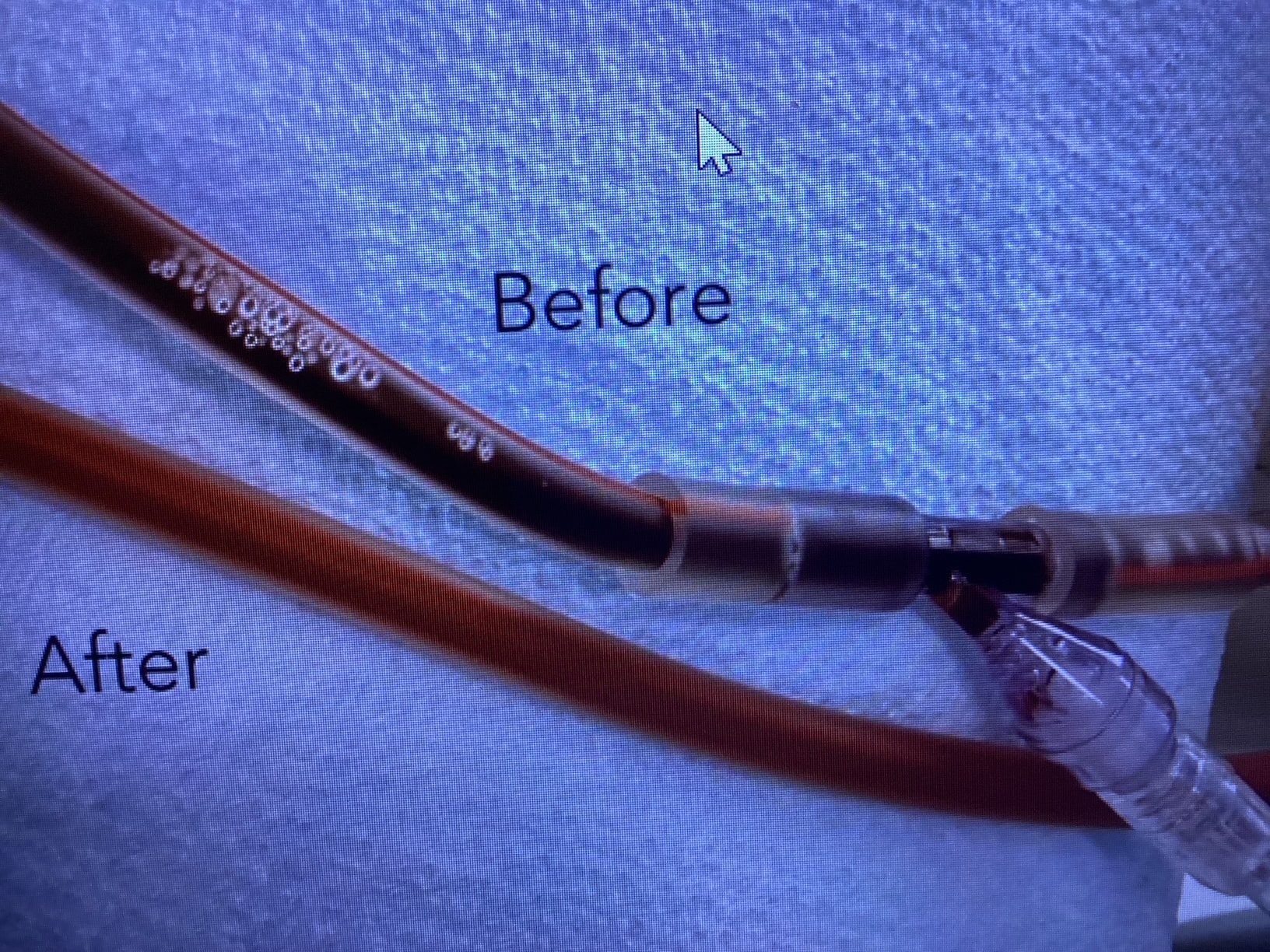 Before and after EBOO patient treatment setup